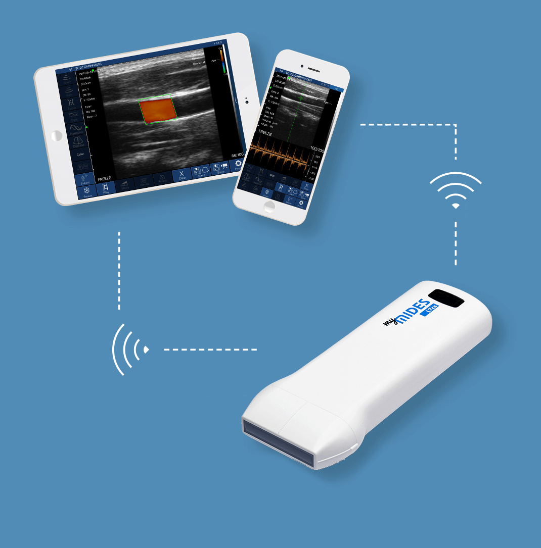 myMIDES, mobile ultrasound probe
